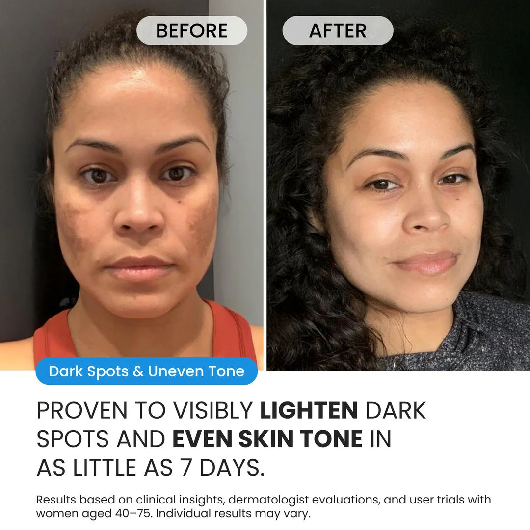 Dark Spot Corrector for Dark Spots, Melasma & Uneven Skin Tone