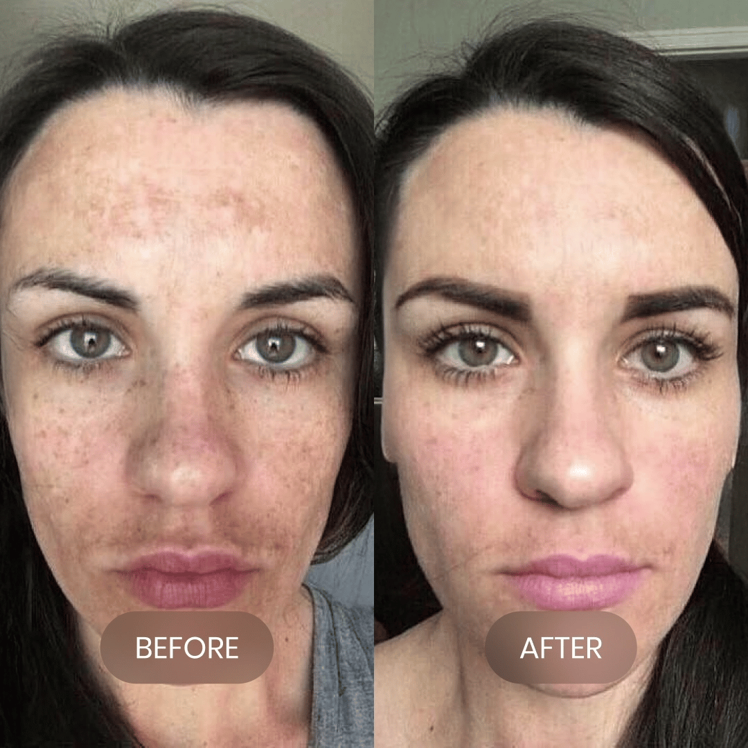 <p>Years of spots, <em>gone in weeks</em></p>