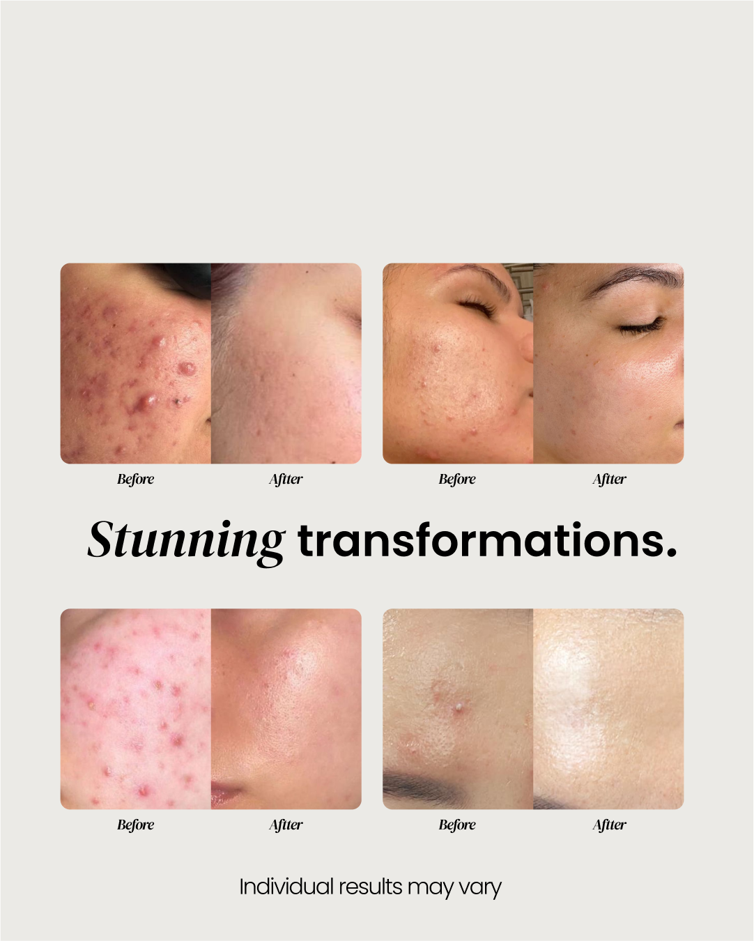 Daytime Pimple Patch
